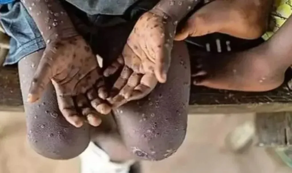 Maymun Çiçeği Afrika’da endişelendiriyor