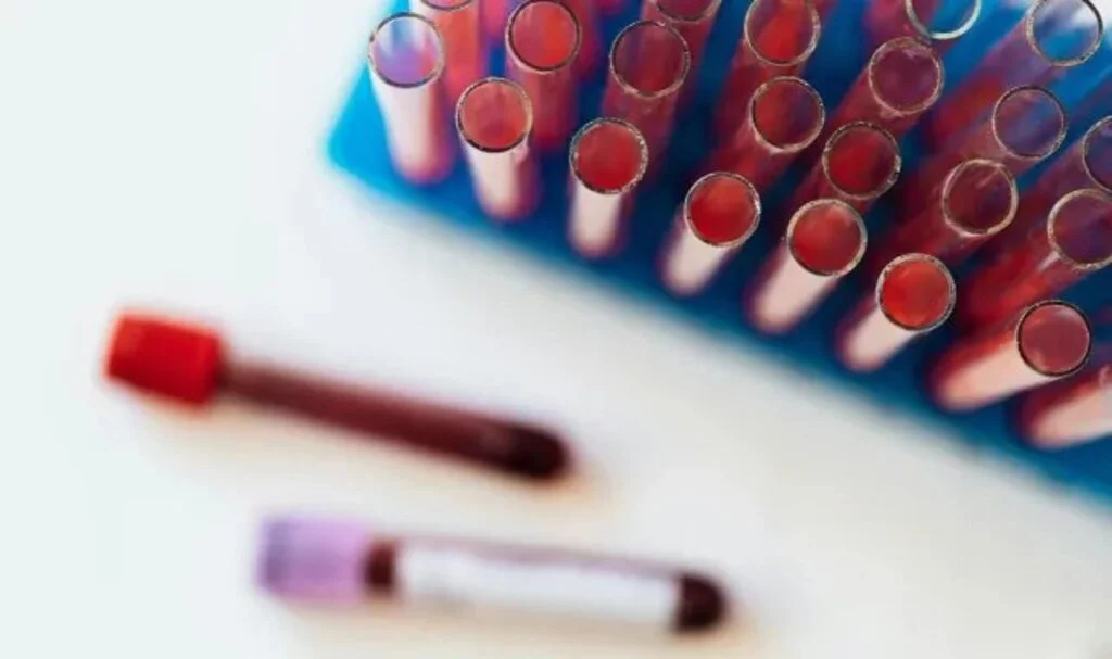 Hematoloji Nedir Hangi Hastalıklara Bakar