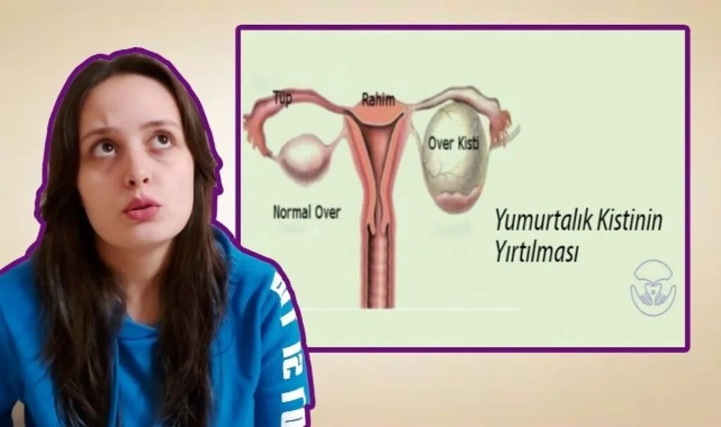 Yumurtalık Kisti Belirtileri Nasıl Anlaşılır