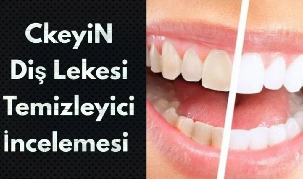Siyah Diş Lekeleri Evde Nasıl Temizlenir