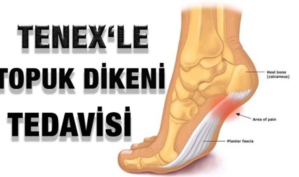 Topuk Dikeni Tedavisi Evde Nasıl Yapılır