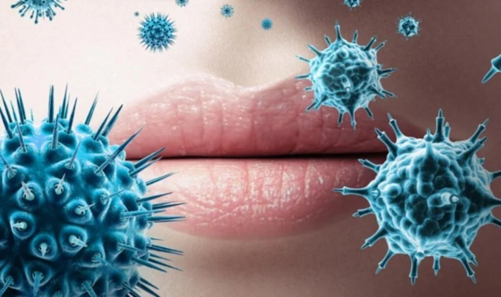 Herpes Virüsü Vücuttan Nasıl Atılır