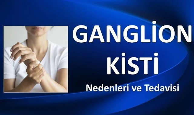 Ganglion Kisti Evde Nasıl Tedavi Edilir